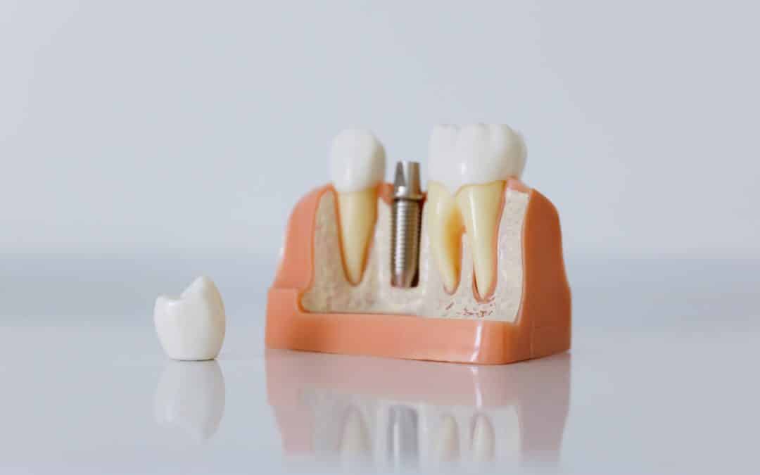 Les trois options les plus courantes pour remplacer une dent manquante.