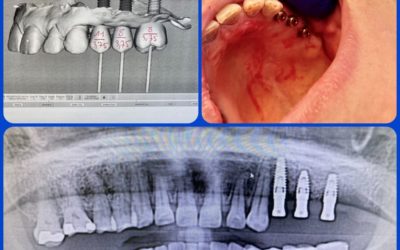 Les questions les plus fréquentes sur les implants dentaires