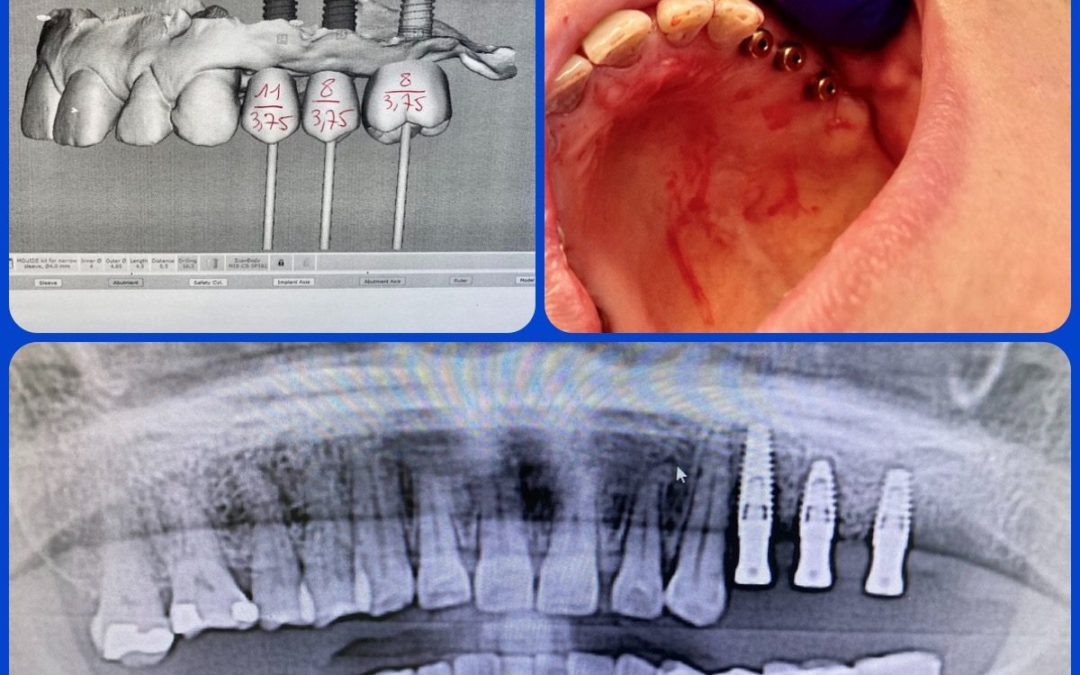 Les questions les plus fréquentes sur les implants dentaires