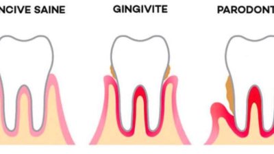 Parodontite : pourquoi vos dents bougent et comment stopper la maladie