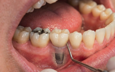 L’implantologie dentaire : comment remplacer une dent manquante avec succès ?